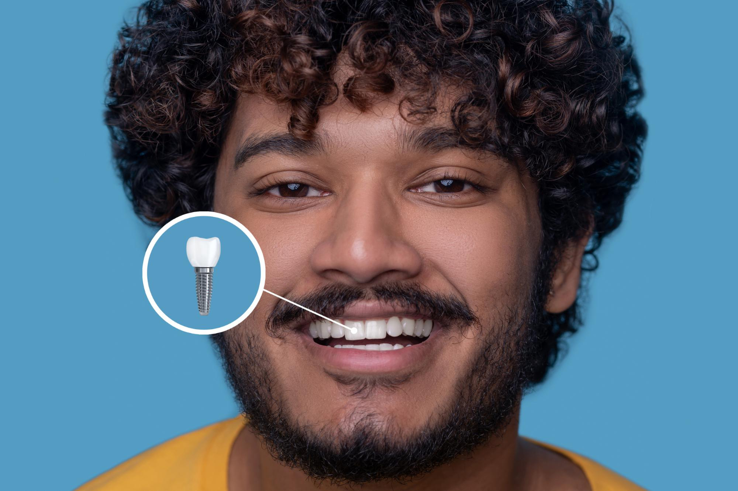 Full Mouth Dental Implants